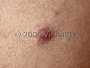 Clinical image of Cutaneous plasmacytoma - imageId=100803. Click to open in gallery.  caption: 'A close-up of a violaceous papule and a maroon nodule.'