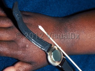Irritant or Object image of Allergic contact dermatitis (pediatric) - imageId=100963. Click to open in gallery.  caption: 'A scaly, hyperpigmented plaque developing on the wrist under a watch, secondary to allergic contact dermatitis to nickel.'