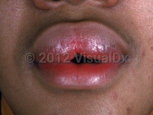 Clinical image of Ascher syndrome - imageId=1015651. Click to open in gallery.  caption: 'Marked edema on the upper lip.'