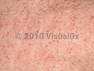 Clinical image of Fabry disease - imageId=1016028. Click to open in gallery.  caption: 'Close-up of myriad tiny red macules and papules (angiokeratomas).'