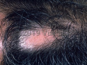 Clinical image of Traumatic alopecia - imageId=1034378. Click to open in gallery. 