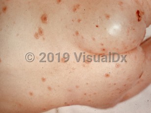 Clinical image of Generalized vaccinia - imageId=1039733. Click to open in gallery.  caption: 'Numerous large vesicles, many crusted, and some interspersed crusts on the back and buttocks.'