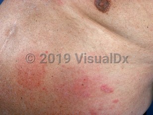 Clinical image of Systemic contact dermatitis - imageId=1052216. Click to open in gallery.  caption: 'Nitroglycerin reaction.'