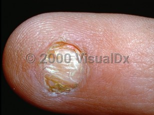 Clinical image of Nail-patella syndrome - imageId=106175. Click to open in gallery.  caption: 'Fingernail with hyponychia, nail plate atrophy, pterygium, and longitudinal ridging.'