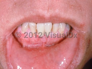 Clinical image of Cowden disease - imageId=1061888. Click to open in gallery.  caption: 'Numerous papules on the gingival mucosa and tiny skin-colored and whitish papules on the upper cutaneous lip (trichilemmomas).'