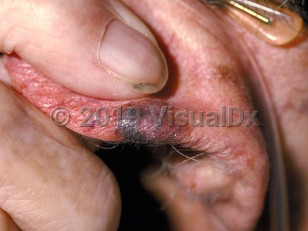 Clinical image of Lentigo maligna melanoma - imageId=107337. Click to open in gallery.  caption: 'A variegated brown, violaceous, and blackish plaque on the helix.'