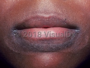 Clinical image of Lip-licking dermatitis - imageId=1085440. Click to open in gallery.  caption: 'A hyperpigmented scaly plaque on the lower cutaneous lip and scaling at the oral commissures.'