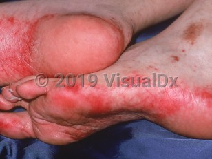Clinical image of Acral erythema - imageId=1101276. Click to open in gallery.  caption: 'Brightly erythematous patches on the soles and lateral foot secondary to doxorubicin.'
