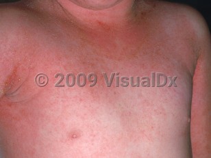 Clinical image of Erythroderma - imageId=1104128. Click to open in gallery.  caption: 'Exanthematous drug reaction displaying widespread erythema over the trunk and arms with superadded crusting around the neck and in axillae.'