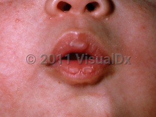 Clinical image of Sucking callus/blister - imageId=111373. Click to open in gallery.  caption: 'A vesicle on the lower aspect of the upper lip.'