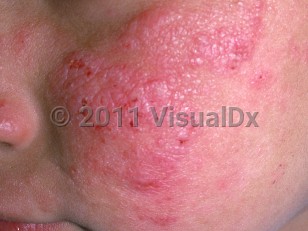 Clinical image of Actinic prurigo - imageId=1125822. Click to open in gallery.  caption: 'Scaly and crusted pink papules and plaques on the cheek.'