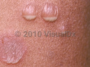 Clinical image of Subcorneal pustular dermatosis - imageId=114300. Click to open in gallery.  caption: 'A close-up of a vesiculopustules, each with a pus/fluid level, and a large flaccid pustule.'