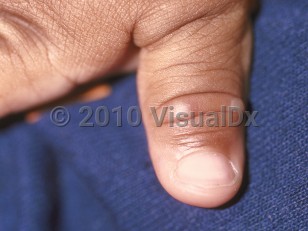 Clinical image of Hand, foot, and mouth disease - imageId=114752. Click to open in gallery.  caption: 'Gray vesicles on the thumb.'