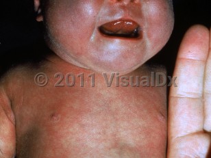 Clinical image of Bronze baby syndrome - imageId=1152246. Click to open in gallery.  caption: 'A generalized gray-brown appearance to the face.'