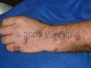 Clinical image of Sporotrichosis - imageId=117226. Click to open in gallery.  caption: 'Crusted and scaly erythematous nodules in a curvilinear configuration (following lymphatics) on the hand and arm.'
