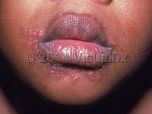 Clinical image of Perioral dermatitis of childhood - imageId=1172467. Click to open in gallery.  caption: 'Numerous substantive pink papules around the mouth.'