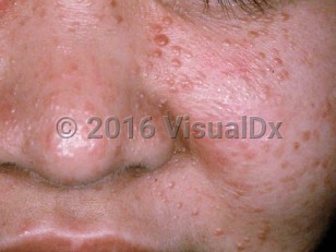Clinical image of Angiofibroma - imageId=1198236. Click to open in gallery.  caption: '"Adenoma sebaceum" (cutaneous angiofibromas) of tuberous sclerosis manifesting as numerous pink and brown papules on the nose, upper cutaneous lip, and cheek.'