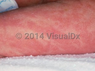 Clinical image of Incontinentia pigmenti - imageId=119964. Click to open in gallery.  caption: 'The vesicular stage, showing patterned erythematous plaques and fine vesiculation on the arm.'