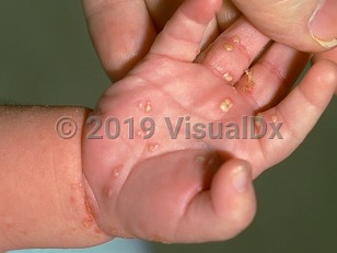 Clinical image of Congenital candidiasis - imageId=120247. Click to open in gallery. 