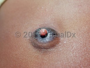 Clinical image of Umbilical polyp - imageId=1244480. Click to open in gallery.  caption: 'A moist, pedunculated, light red papule arising from an everted umbilicus.'