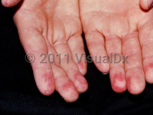 Clinical image of Symmetrical lividity of the palms or soles - imageId=1248320. Click to open in gallery. 