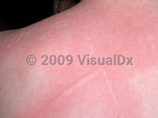 Clinical image of Dermographism - imageId=1308870. Click to open in gallery.  caption: 'Linear pink, edematous plaques with surrounding pink erythema on the back, with similar papules (hives) in the vicinity.'