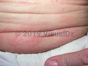 Clinical image of Diffuse cutaneous mastocytosis - imageId=1325657. Click to open in gallery.  caption: 'Edematous skin with a peau d'orange appearance and overlying urticarial plaques on the abdomen.'