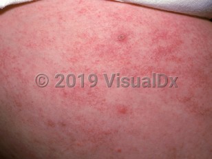 Clinical image of Telangiectasia macularis eruptiva perstans - imageId=1326196. Click to open in gallery.  caption: 'Numerous telangiectatic macules and patches on the thigh with 3 small wheals (positive Darier sign).'