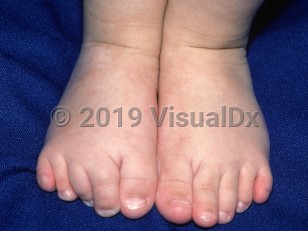 Clinical image of Nager syndrome - imageId=1337665. Click to open in gallery. 