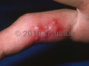 Clinical image of Herpetic whitlow - imageId=133823. Click to open in gallery.  caption: 'A cluster of cloudy vesicles and some small crusts on a brightly erythematous base on the finger.'