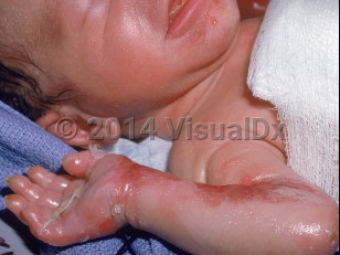 Clinical image of Generalized severe epidermolysis bullosa simplex - imageId=1354140. Click to open in gallery.  caption: 'Sheets of desquamation and large crusted erosions on the arm with some vesicles on the chin.'