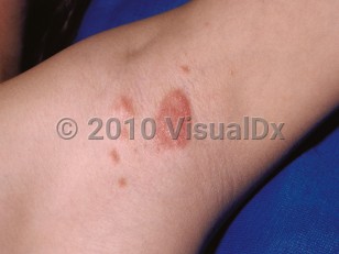 Clinical image of Inverse psoriasis - imageId=14015. Click to open in gallery.  caption: 'Well-demarcated, salmon-pink papules with scant scale and a similar plaque in the axilla.'