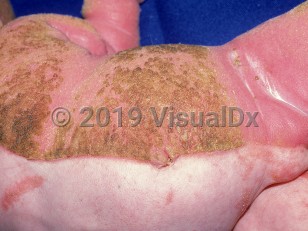 Clinical image of CHILD syndrome - imageId=1403292. Click to open in gallery.  caption: 'Diffuse hyperkeratotic, pink plaques involving the left arm and leg and the left side of the trunk with a sharp midline cutoff. Note similar scant plaques with a blaschkoid configuration on the right side.'