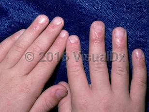 Clinical image of Dyskeratosis congenita - imageId=1405839. Click to open in gallery.  caption: 'A thinned fingernail plate and pink plaques at the distal fingers.'