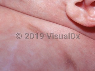 Clinical image of Anetoderma of prematurity - imageId=1421923. Click to open in gallery.  caption: 'Atrophic light brown-gray plaques on the chest.'