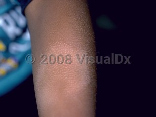 Clinical image of Pityriasis alba - imageId=143728. Click to open in gallery.  caption: 'A thin hypopigmented plaque with follicular prominence on the arm.'