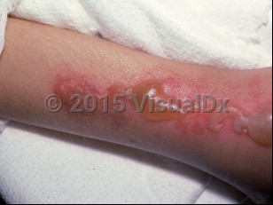 Clinical image of Coma bullae - imageId=1437776. Click to open in gallery.  caption: 'A linear array of tense and flaccid bullae and background erythema on the leg.'