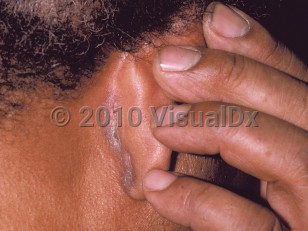 Clinical image of Seborrheic dermatitis - imageId=144205. Click to open in gallery.  caption: 'Thin scaly plaque in the post-auricular fold.'