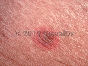 Clinical image of Fixed drug eruption - imageId=1453376. Click to open in gallery.  caption: 'A close-up of a round bright red plaque with a central darker color.'