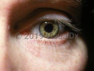 Clinical image of Iris freckle - imageId=1471309. Click to open in gallery.  caption: 'Tiny brown macules on the iris.'