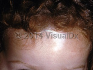 Clinical image of Waardenburg syndrome - imageId=1478399. Click to open in gallery.  caption: 'A depigmented patch and tiny similar nearby macules on the upper central forehead. Note also the associated white forelock.'