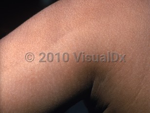 Clinical image of Futcher lines - imageId=1482972. Click to open in gallery.  caption: 'A sharp demarcation line dividing darker and lighter portions of the arm.'