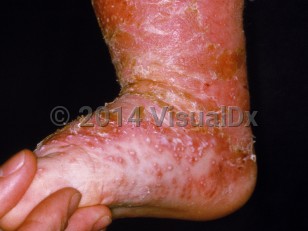 Clinical image of Infantile psoriasis - imageId=14990. Click to open in gallery.  caption: 'Pustular psoriasis in an infant displaying a large crusted and scaly erythematous plaque on the leg and foot, with outlying tiny pustules on the foot.'
