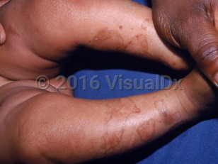 Clinical image of Kindler syndrome - imageId=1503825. Click to open in gallery.  caption: 'Postinflammatory hyper- and hypopigmentation following bulla resolution on the legs.'