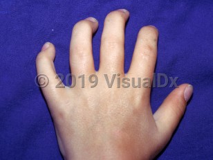 Clinical image of Scheie syndrome - imageId=1511815. Click to open in gallery.  caption: 'Joint contractures of the fingers.'