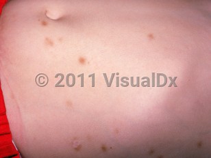 Clinical image of Toxocariasis - imageId=1534666. Click to open in gallery.  caption: 'Hyperpigmented macules on the abdomen and flank.'