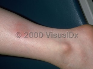 Clinical image of Subacute nodular migratory panniculitis - imageId=153672. Click to open in gallery.  caption: 'A minimally elevated erythematous plaque on the lateral shin with a crescentic configuration.'