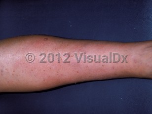 Clinical image of Calciphylaxis - imageId=153991. Click to open in gallery.  caption: 'Circumferential, erythematous plaque on the lower leg.'