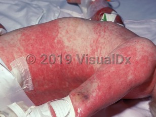 Clinical image of Acquired pancytopenia - imageId=1552640. Click to open in gallery. 