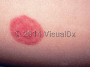 Clinical image of Acute hemorrhagic edema of infancy - imageId=1584128. Click to open in gallery. 